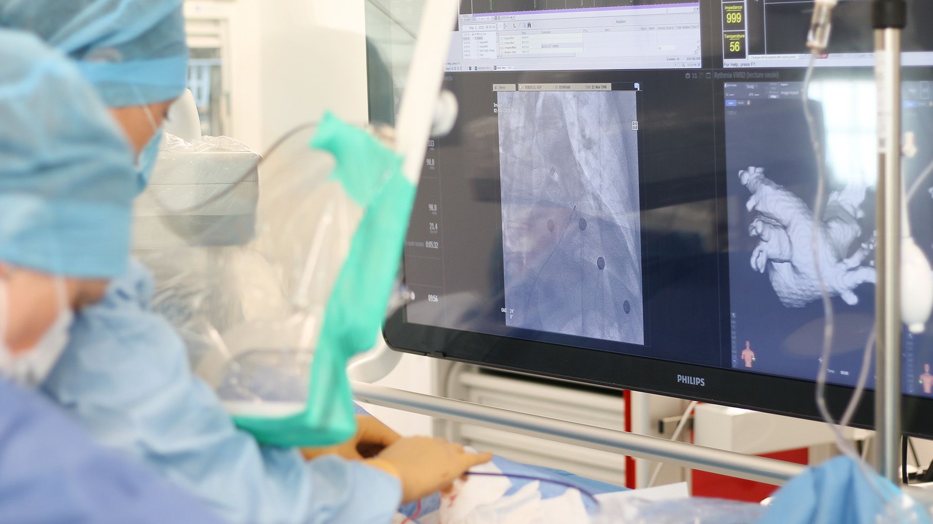 CHU Caen Normandie bietet eine neue Technik zur Ablation von Vorhofflimmern an