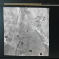 Ablation von Vorhofflimmern durch Elektroporation